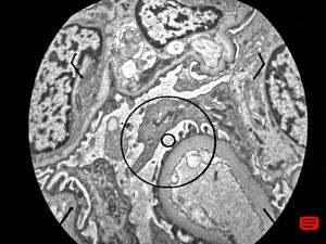 M,6y. | Alport syndrome- digital photo from the screen M,6y. | Alport syndrome- digital photo from the screen